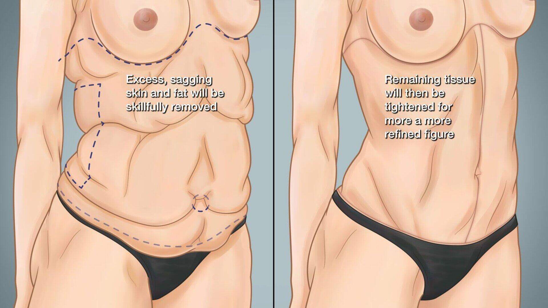 Loose skin after weight loss? How to tighten it